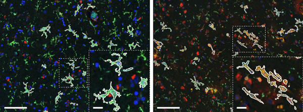 Iron Loading in Alzheimer’s Disease screenshot