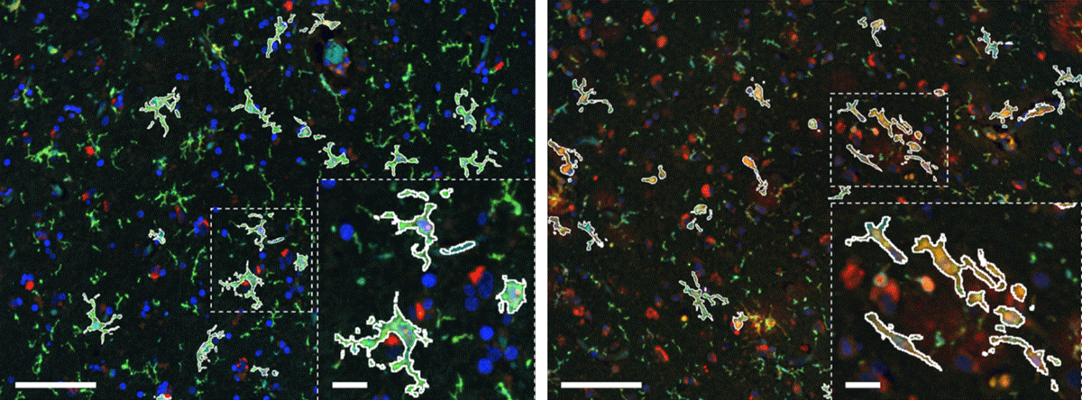 Iron Loading is a Prominent Feature of Activated Microglia in Alzheimer’s Disease Patients teaser image