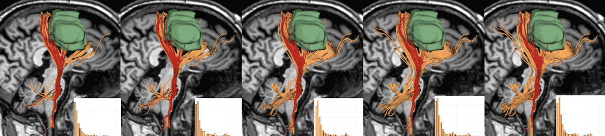 A Progressive Approach for Uncertainty Visualization in Diffusion Tensor Imaging teaser image