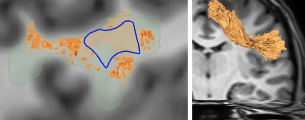 Sensitivities in Fiber Tracking screenshot