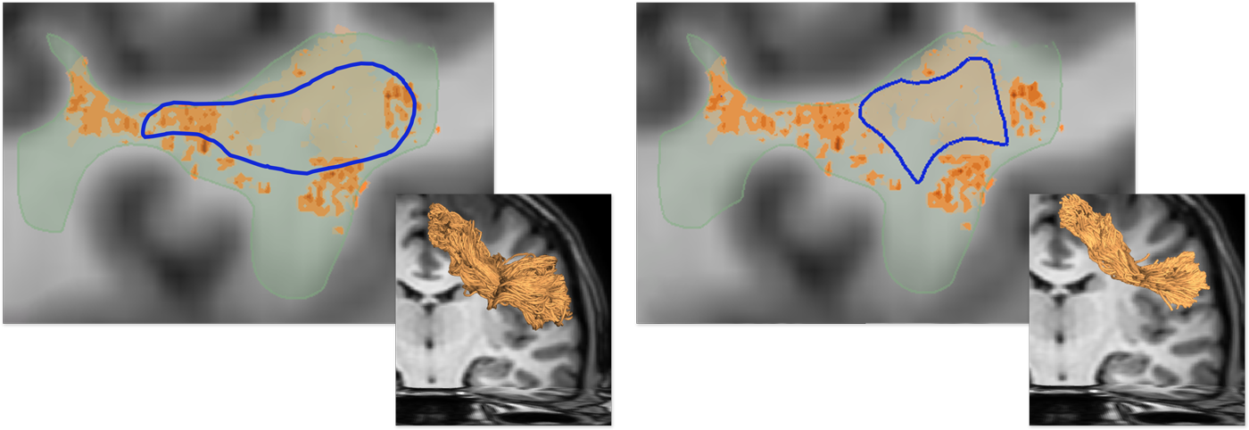 Interactive Visual Exploration of Region-Based Sensitivities in Fiber Tracking teaser image